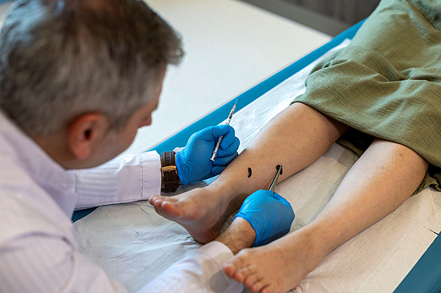 Pijavice a baňkování po úplňku. Do tureckých nemocnic se vrací staré metody