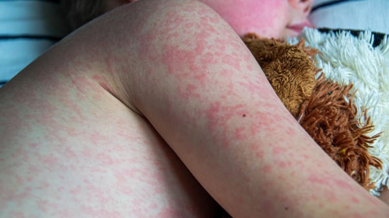 Epidemie spalniček? Nákaz přibývá, je to horší než před covidem, bijí na poplach experti